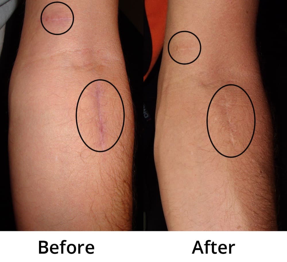 Before and after comparison of a forearm scar treated with MPS scar release therapy, showing the scar visibly softened and faded